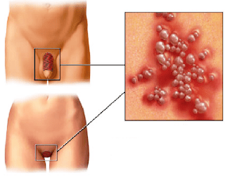 Obat Sipilis Buat Sendiri