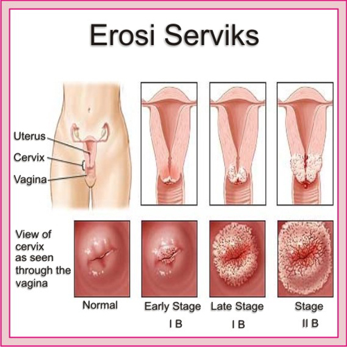 Obat Sipilis Di Puskesmas