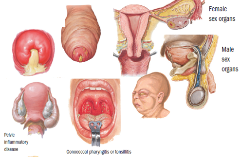 Obat Sipilis Dengan Bawang Putih