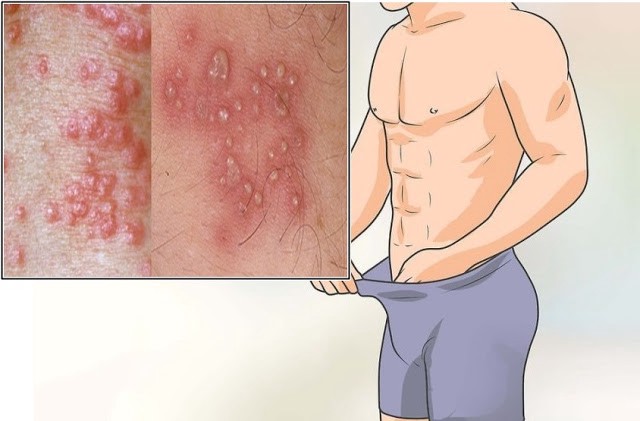 Obat Herbal Sipilis Pria